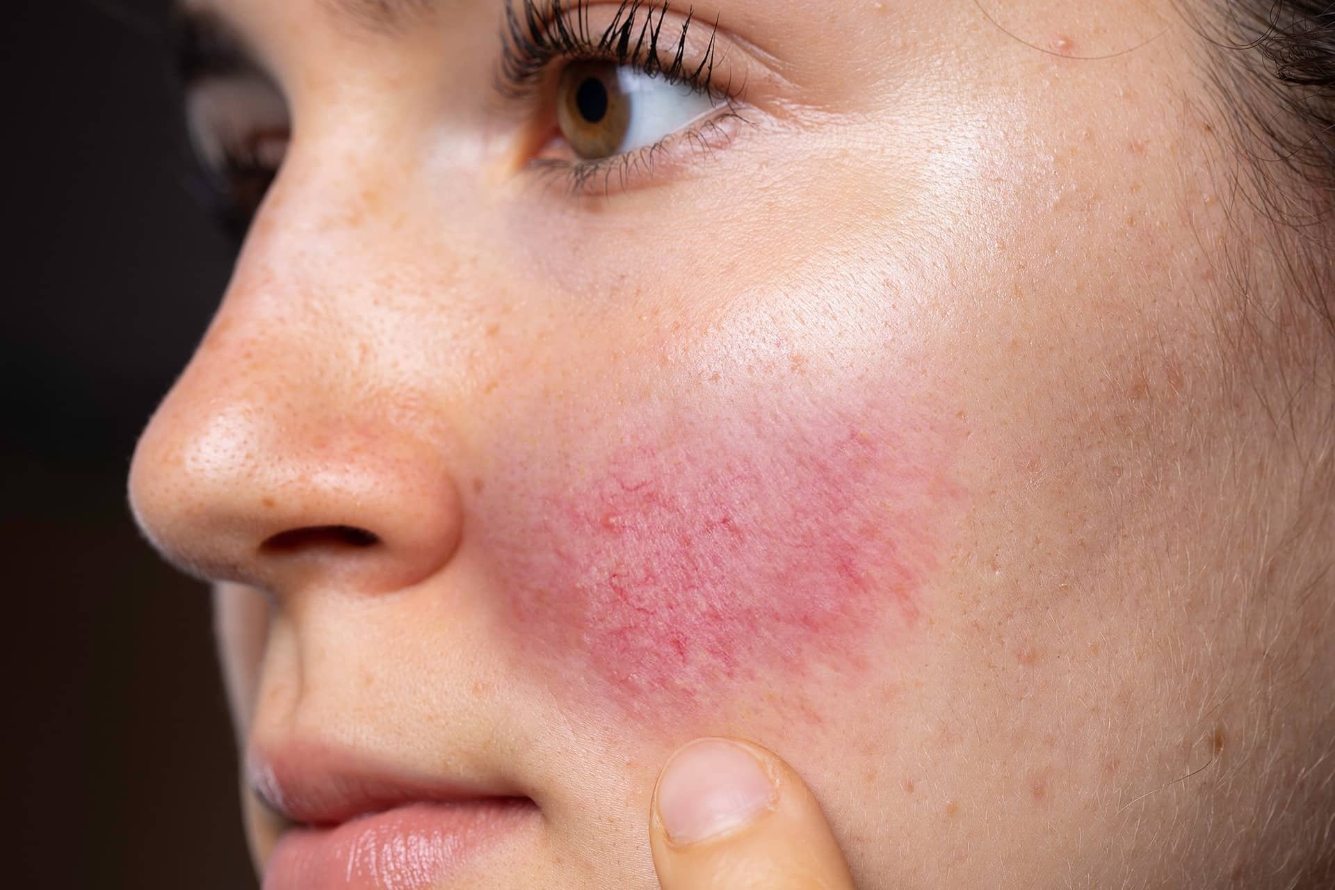 What Causes Redness On The Skin? - A Comprehensive Guide